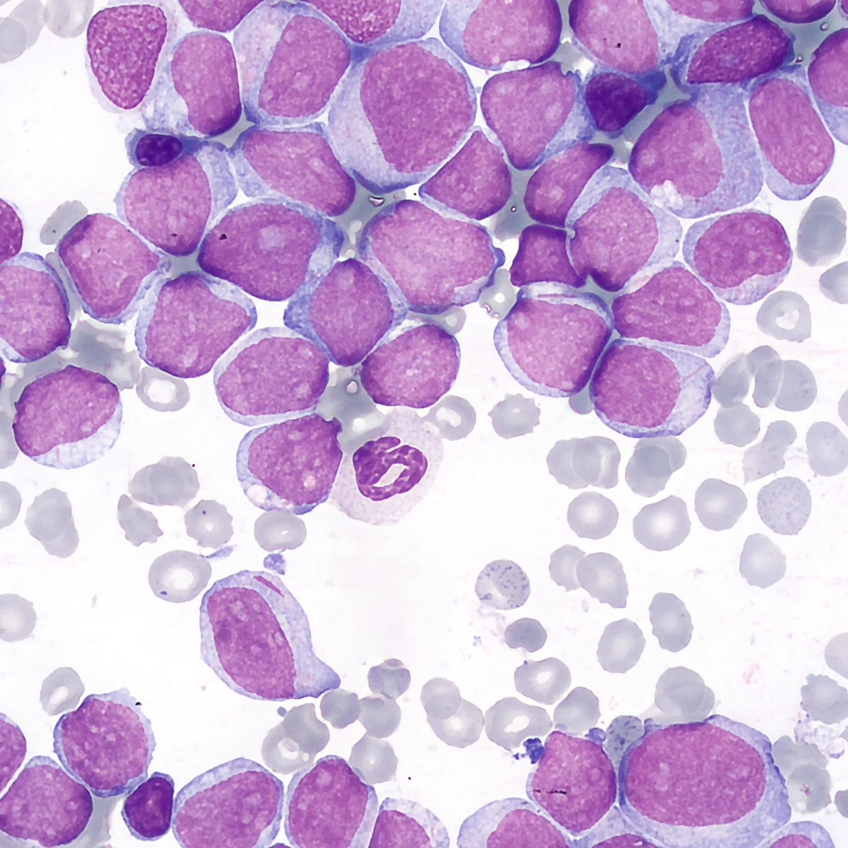 Bone marrow smear showing acute myeloid leukemia, with large purple blast cells crowded together and smaller pale red blood cells scattered around them.