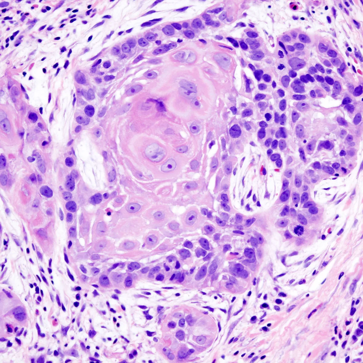 Close-up histopathology slide of squamous cell carcinoma showing a nest of tumor cells with a central keratin pearl surrounded by dense purple nuclei.